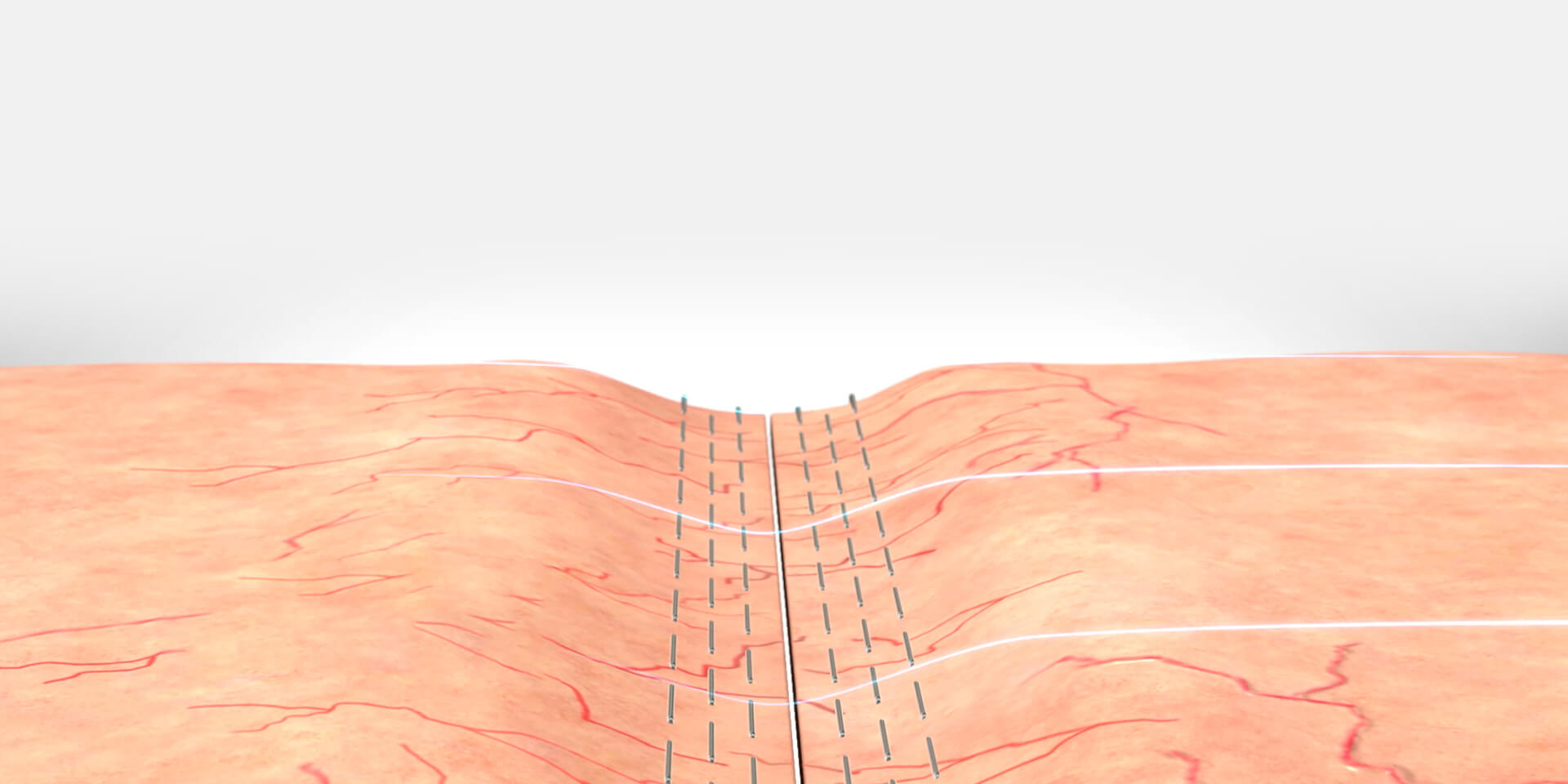 QELC technology detail